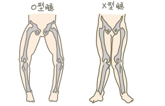 o型腿的原因是什么如何矫正o型腿