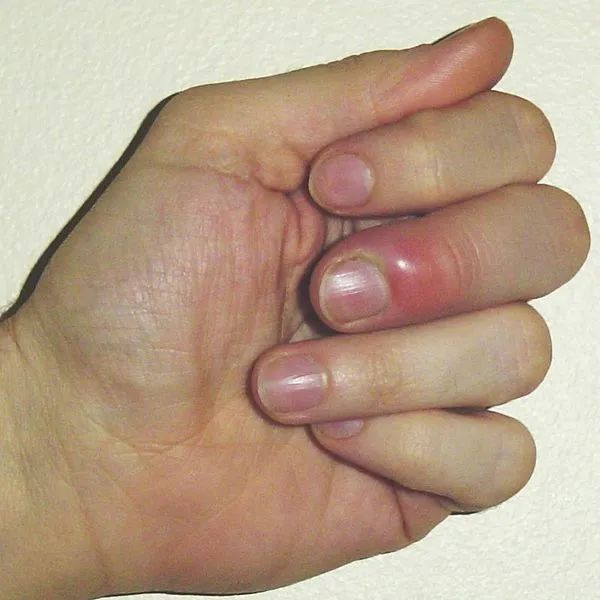 如何正确剪指甲 操作不当有可能得甲沟炎